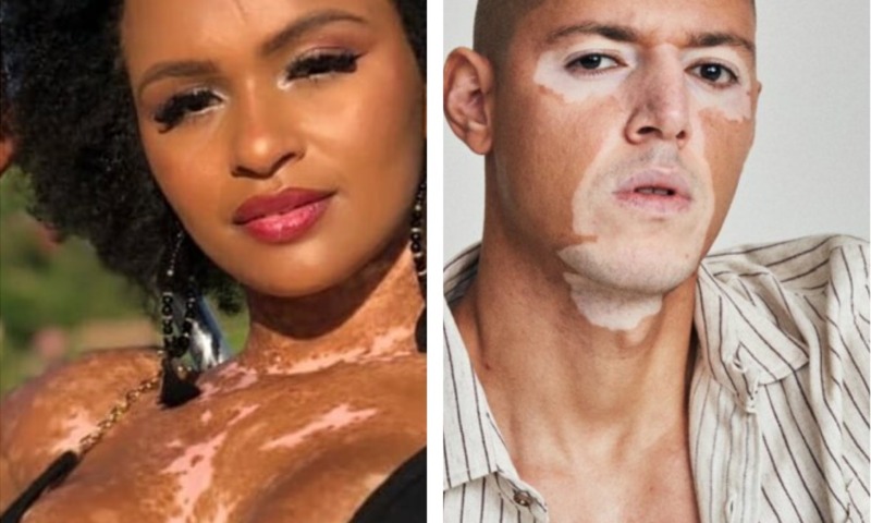 BBB22: 'Natália precisou ser empoderada para se afirmar', diz modelo Vitor  Maccla que milita sobre o vitiligo - Heloisa Tolipan