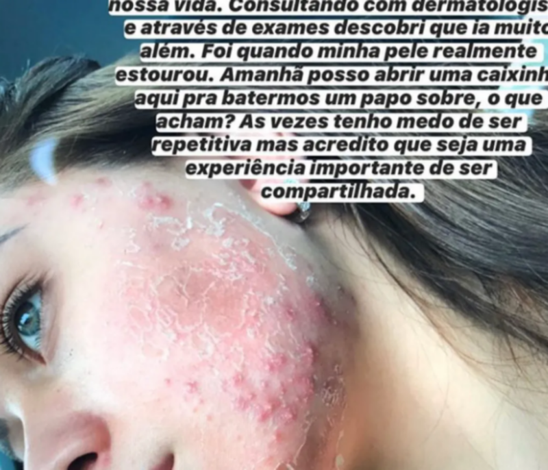 Flavia Pavanelli sofria de desregulações hormonais por conta da SOP (Reprodução/Instagram)